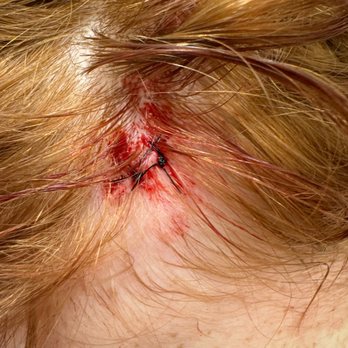 St Timothy Urgent Care - stitches complete - Urgent Care Near Me - Odessa, Florida St Timothy Urgent Care - stitches complete - Urgent Care Near Me - Odessa, Florida