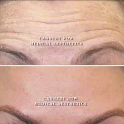 Cannery Row Medical Aesthetics - Botox Cosmetics