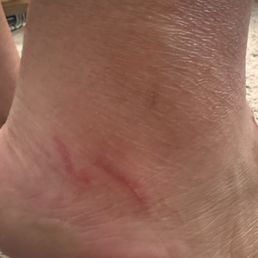 Here's the picture where I was cut twice on the side of my foot when she was scrubbing my feet Here's the picture where I was cut twice on the side of my foot when she was scrubbing my feet