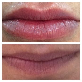 ShotDocMD - Lip volume enhanced with 1cc Juvederm Volbella. - Medical Spas Near Me - Los Gatos, California