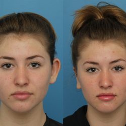 OTOPLASTY (EAR SURGERY) BY DR. CAMERON FRANCIS