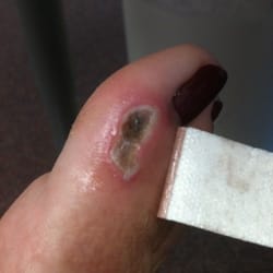 Solar Nails & Spa - Look what they did to my poor aunties foor =( this salon is horrible read all the reviews about INFECTIONS I'm not the only one!