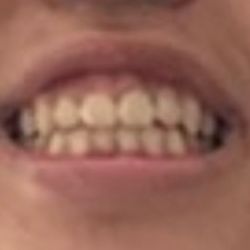 Miao Orthodontics & Angela Chow Children's Dentist - Underbite fixed and is now using retainers.