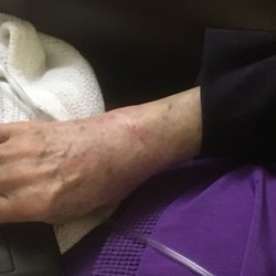 Rae-Ann Suburban - Swollen maybe broken wrist that has not gotten adequate care