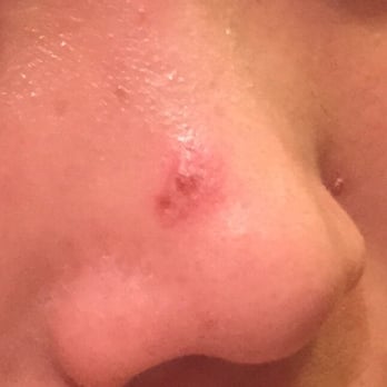 Paul Labrecque Salon & Spa - Day after facial with bad extraction - Hair Salons Near Me - New York, New York