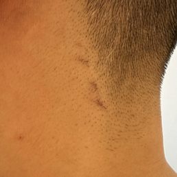 Cut on neck from incompetent straight razor use. Cut on neck from incompetent straight razor use.