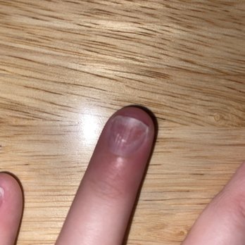 Blossom Nails Spas - The day I soaked it off... after soaking and cleaning the initial infection out from Under my nail - Nail Salons Near Me - Harrisonburg, Virginia