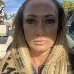 Botox in forehead (2 weeks) and lip filler right after injections.