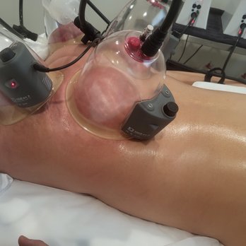 ACUREVERSE - Cupping on my booty, to improve circulation. - Acupuncture Near Me - Costa Mesa, California
