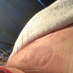 Bao's Healing Center - Acupuncture - the most effective source of healing