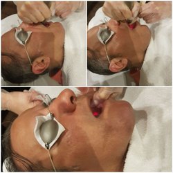 Absolute Medi Spa - Our Unique way of Skin Tightening as client is doing Intra-Oral SmoothLiftin. Call us for a free consultation at 905 897 0772