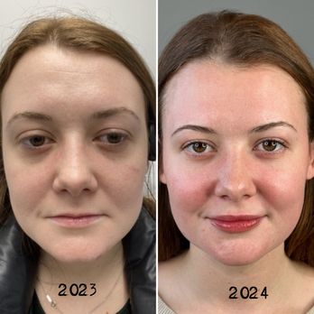 Rodelyn Medical Aesthetics - Before and After a year - Medical Spas Near Me - Irvington, New York Rodelyn Medical Aesthetics - Before and After a year - Medical Spas Near Me - Irvington, New York