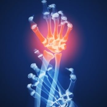 Orthopedic Hand Surgeon - Dr. Jeffrey E. Budoff, MD - Hand Surgery - Orthopedists Near Me - Houston, Texas Orthopedic Hand Surgeon - Dr. Jeffrey E. Budoff, MD - Hand Surgery - Orthopedists Near Me - Houston, Texas