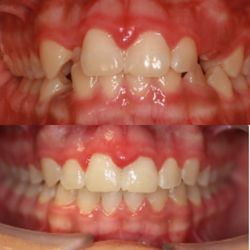 Toothworks of Bakersfield - Before and after Braces