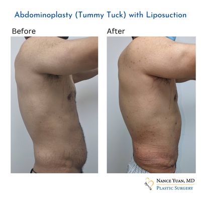 Abdominoplasty - Abdominoplasty or commonly known as the tummy tuck, is a procedure where the excess fat and abdominal skin is removed, leaving a flatter stomach. Abdominoplasty - Abdominoplasty or commonly known as the tummy tuck, is a procedure where the excess fat and abdominal skin is removed, leaving a flatter stomach.