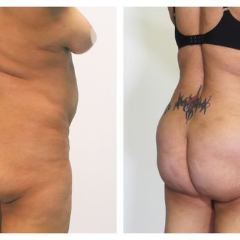 MyShape Lipo - Medical Spas Near Me - Henderson, Nevada