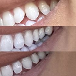 Shirin Etemadi, DDS - A Brilliant Smile - Top photo shows how disproportioned my tooth was after the filling. Middle and bottom pictures are my teeth before she butchered them