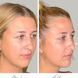 Sarasota Facial Aesthetics - Sarasota Facial Aesthetics Juvederm Treatment