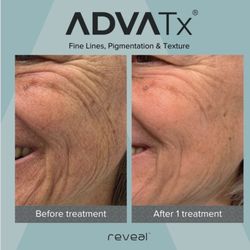 Glo Aesthetics - Fine lines, pigmentation, and texture