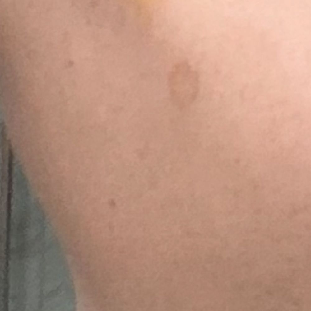 SENA Spa - Bruised shoulder from massage - Eyelash Service Near Me - New York, New York