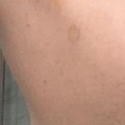 Bruised shoulder from massage