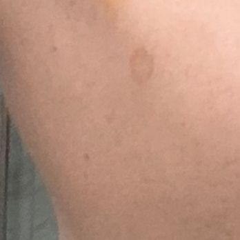 SENA Spa - Bruised shoulder from massage - Eyelash Service Near Me - New York, New York