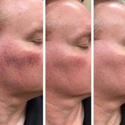 Renu Aesthetics & Wellness - Experiencing spider veins? Vasculaze with Microneedling RF can help you achieve glass skin and more confidence.