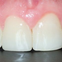 Adomian Garo, DDS - Patient came in with a broken bonding and left the same day with this veneer utilizing CEREC.  Can you guess which tooth has the veneer?