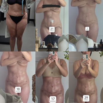 Sono Bello - May 19th revison day, followed by the next 6 wks post op. - Cosmetic Surgeons Near Me - Woburn, Massachusetts Sono Bello - May 19th revison day, followed by the next 6 wks post op. - Cosmetic Surgeons Near Me - Woburn, Massachusetts