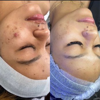 Glow Haus - Scars - Estheticians Near Me - Redondo Beach, California