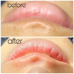 Distinguished Gentlemen's Spa - Blackhead removal