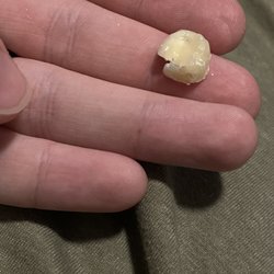 Southern Family Dental - Crown that cracked