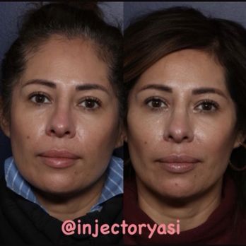 Ahava Medspa - Before and After - Medical Spas Near Me - Rancho Cucamonga, California