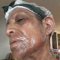 Beacon Medical Group Dermatology Ireland Road - Or the fleas bit my face