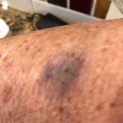 White Buffalo Spiritual Healing and Gifts - Bruise with fang mark