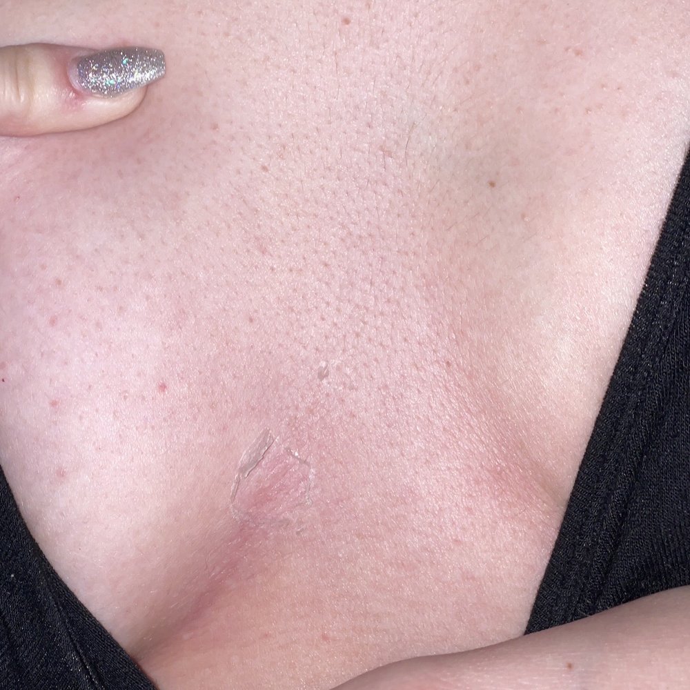 Bodyheat Tanning - CHEST BURN BLISTERS STARTING TO PEEL - Tanning Near Me - Henderson, Nevada