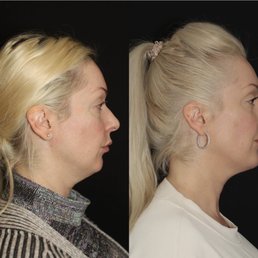 Juvaderm injected by Jennay at Dr Savalia's Chin, cheeks, jawline Juvaderm injected by Jennay at Dr Savalia's Chin, cheeks, jawline
