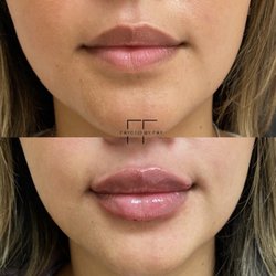 Lip Augmentation by Nurse Fay.