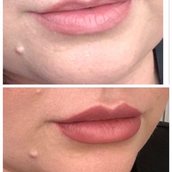 Morpheus Medical Aesthetics - Before and 24 hours after the procedure - Medical Spas Near Me - Santa Rosa, California