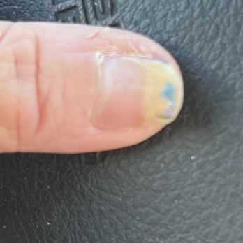 Le Venus Spa - My left thumb, which is the worst of out the other 4 fingers that are affected. - Day Spas Near Me - Montrose, California Le Venus Spa - My left thumb, which is the worst of out the other 4 fingers that are affected. - Day Spas Near Me - Montrose, California