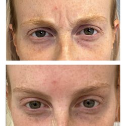 Ari Blanc Medical Spa - Botox / Dysport Anti-Wrinkle Injections for 11's or Glabellar Lines at Ari Blanc | Before & After