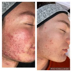 Aesthetic's Skin & Acne Care