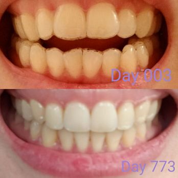 Humphries Orthodontics - Before and after - Orthodontists Near Me - Orange, California