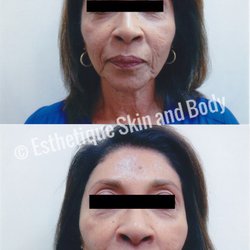 Esthetique Skin and Body - Skin tightening treatment, heat the tissue underneath to stimulate collagen production. Lessen fine lines, textures, wrinkles.