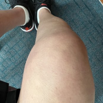 Nanoknee Institute - Pre op photo of right knee - Surgeons Near Me - Torrance, California