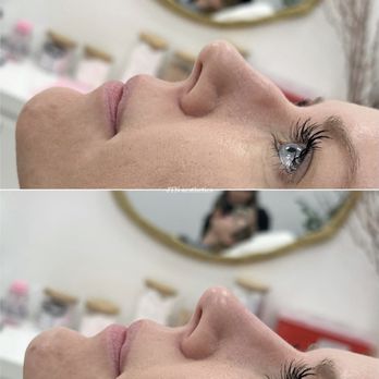 JTN Aesthetics - SERVICE: Nose Filler (NSNJ)
PRODUCT: Voluma
PRICE: $1200 - Medical Spas Near Me - Huntington Beach, California JTN Aesthetics - SERVICE: Nose Filler (NSNJ)
PRODUCT: Voluma
PRICE: $1200 - Medical Spas Near Me - Huntington Beach, California