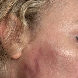 Fountain Hills MedSpa - This doctor gave me an infection which resulted in scars on my face.