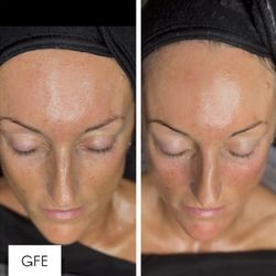 Glow Forth Esthetics - "The Works" Facial in action
- Dermaplanning
- Brightening Enzyme Treatment
- Double Masque with Steam
- Nanoneedling peptides