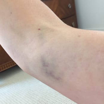 Labcorp - 2 days after I had my blood drawn and I still can't bend it all the way. - Laboratory Testing Near Me - Laguna Hills, California Labcorp - 2 days after I had my blood drawn and I still can't bend it all the way. - Laboratory Testing Near Me - Laguna Hills, California