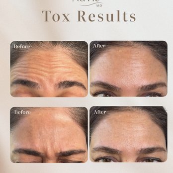 NuVie MD - Letybo tox results after two weeks of injection - Medical Spas Near Me - Irvine, California NuVie MD - Letybo tox results after two weeks of injection - Medical Spas Near Me - Irvine, California